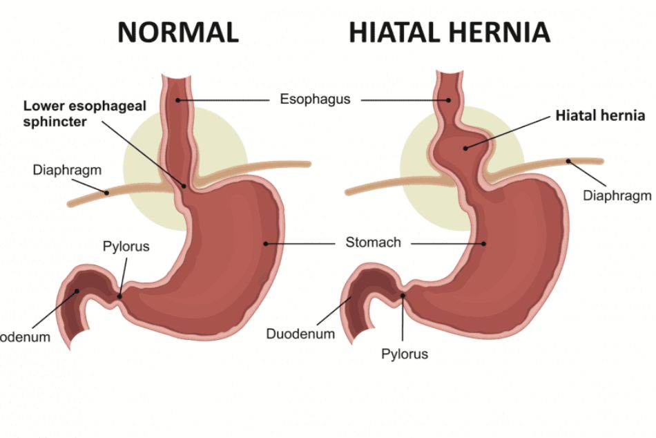 hiatal hernia