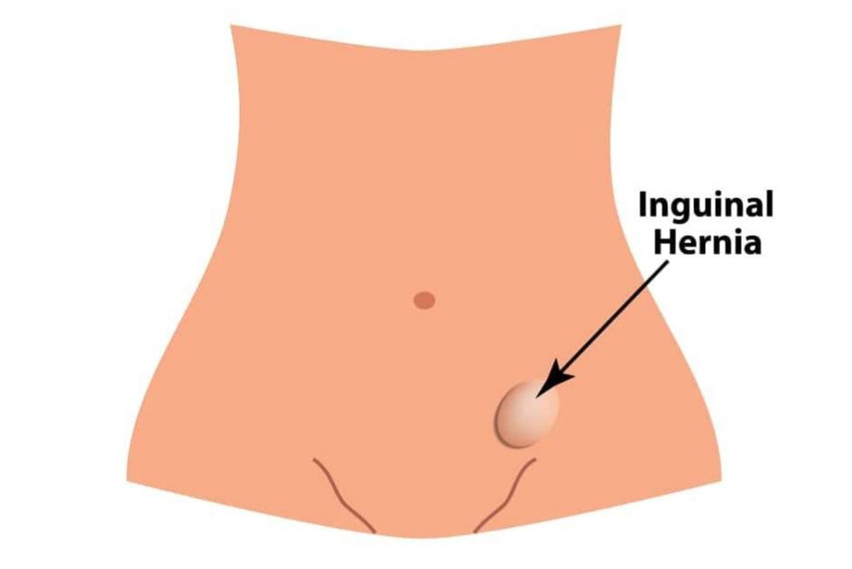 inguinal hernia